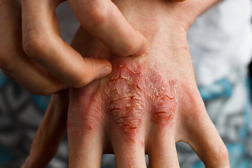 Psoriasis auf der Haut
