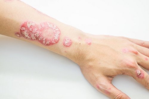 Schuppenflechte an Hand und Arm
