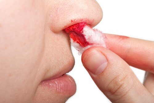 Tipps gegen Nasenbluten