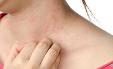 Urtikaria mit Naturheilmitteln lindern