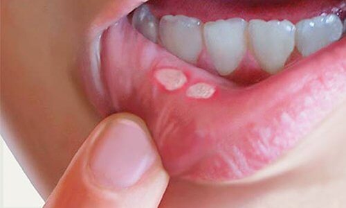 Was tun bei Wunden im Mund? Hilfreiche Naturheilmittel