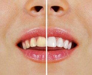 Aufhellung der Zähne mit Naturprodukten