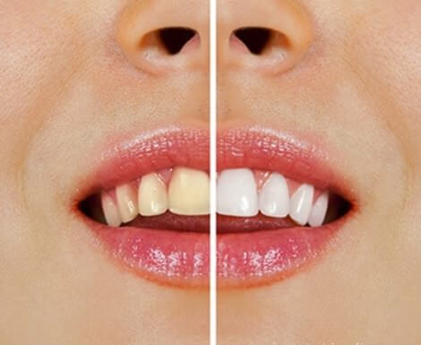 Aufhellung der Zähne mit Naturprodukten