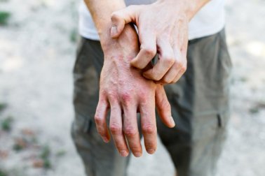 Kontaktdermatitis: 6 effektive Hausmittel
