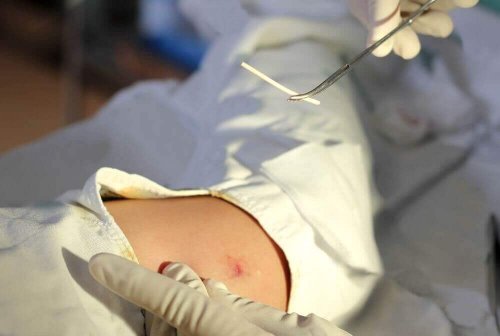 Progestagen-Implantat und dennoch schwanger werden, geht das?