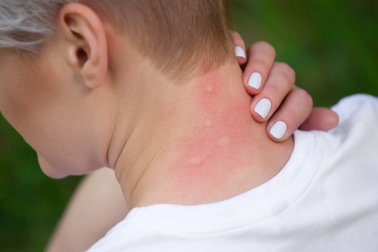 Fenistil gegen Insektenstiche und Nesselauschlag