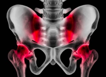 Schambeinentzündung: Ursachen und Symptome