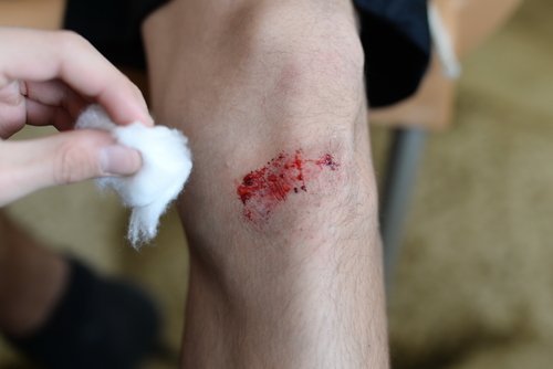 Augeschürftes Knie behandeln