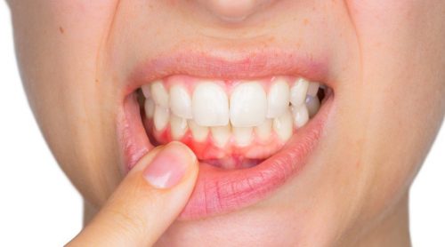 Abszess am Zahn: Ursachen und Behandlungsmöglichkeiten