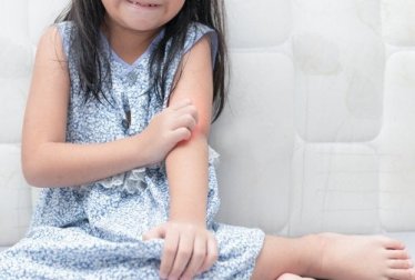 Schuppenflechte bei Kindern