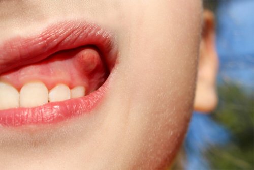 Was ist ein Abszess am Zahn?