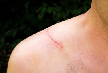 Natürliche Narbensalbe selber machen