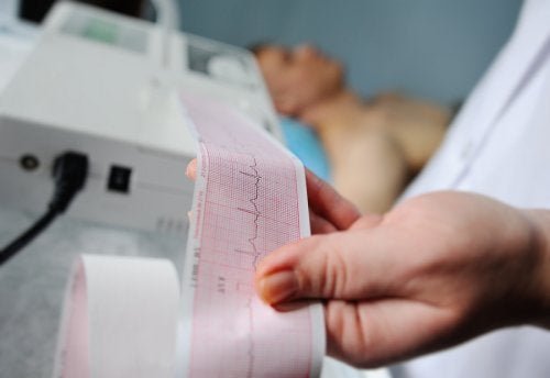 Ein Elektrokardiogramm in 7 Schritten auswerten