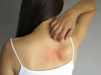 Ausschlag lindern: 5 Mittel zur äußeren Anwendung