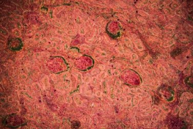 Nierentuberkulose: Diagnose und Behandlung