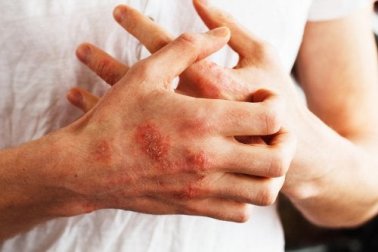 Ernährung bei Schuppenflechte: verschiedene Empfehlungen
