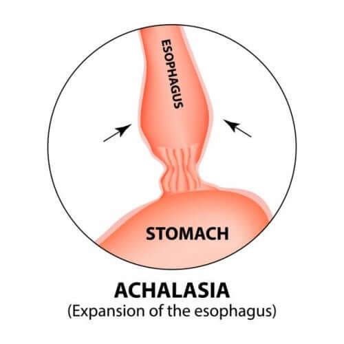 Bild zur anamtomischen Erklärung der Achalasie