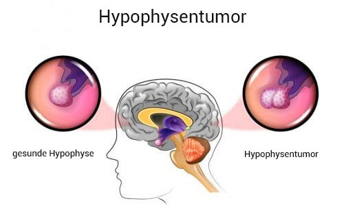 Hypophysentumor: Ursachen und Symptome