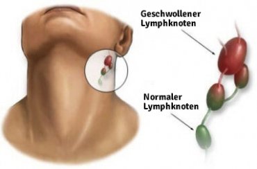 Knoten am Hals: nützliche Informationen - Besser Gesund Leben