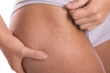 Creme mit Vitamin E gegen Dehnungsstreifen