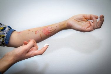 Oberflächliche Verbrennungen: Erste Hilfe