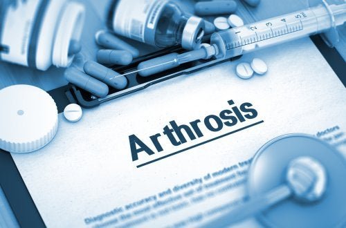 Gelenkerkrankungen: Arthrose