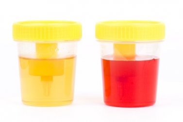 Hämaturie: Symptome und Ursachen