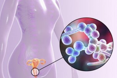 Wissenswertes über vulvovaginale Candidose