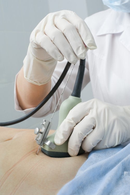 Diagnose von Adenomyosis uteri