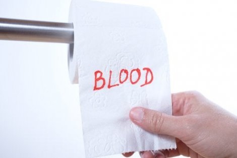 Blut im Stuhl: mögliche Ursachen