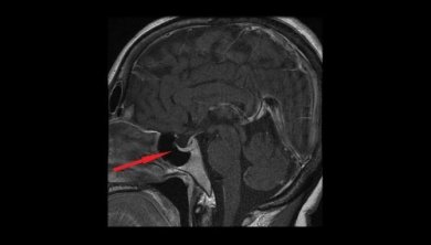 Wissenswertes über das Hypophysenadenom