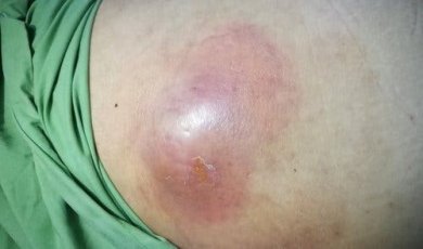 Intraabdominale Abszesse: Was ist das?