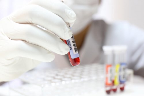 Agranulozytose: Person führt Blutanalyse durch