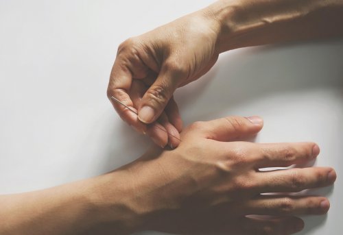 Akupunktur bei Gelenkschmerzen: Zwei Hände mit Akupunkturnadel