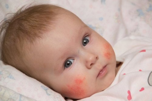 Atopisches Ekzem bei Babys: Was ist das?