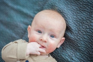 Atopisches Ekzem bei Babys: die wichtigsten Pflegemaßnahmen