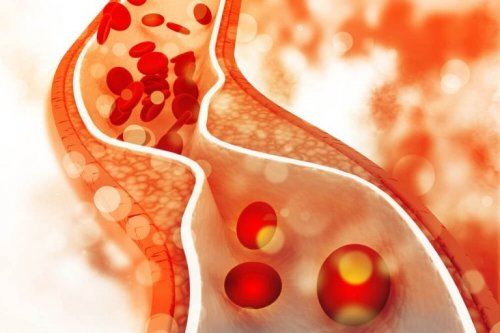 Johannisbrotkernmehl reduziert den Cholesterinspiegel