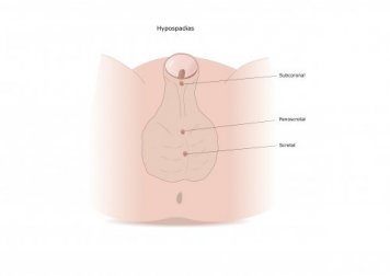 Hypospadie: Ursachen und Behandlung