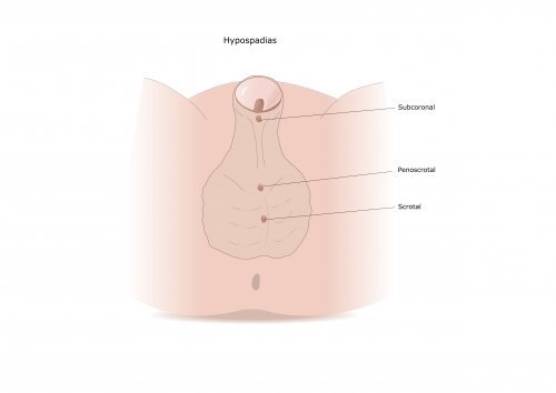 Hypospadie: Ursachen und Behandlung