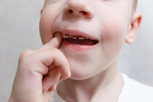 Kind mit Zahnkaries