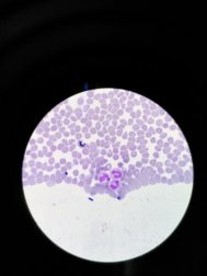 Agranulozytose: Symptome und Behandlung