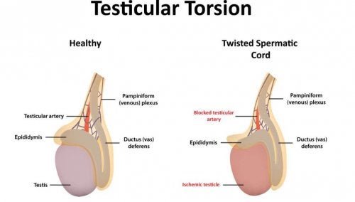 Hodentorsion: Symptome und Ursachen