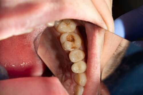 Was ist Zahnkaries und wie entsteht sie?