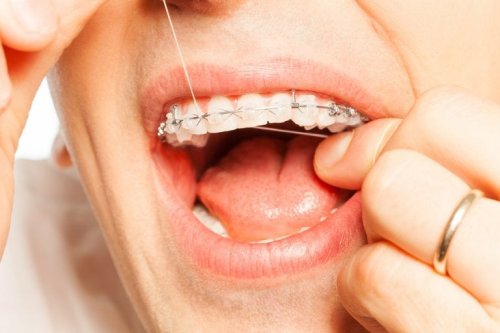 Zahnseide bei einer Zahnspange