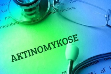 Aktinomykose: Krankheitsbild und Behandlung