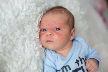 Atopische und Seborrhoische Dermatitis: Was ist der Unterschied?