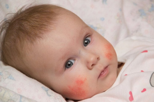 Atopische und Seborrhoische Dermatitis