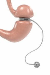 Magenband: Wofür wird es eingesetzt?