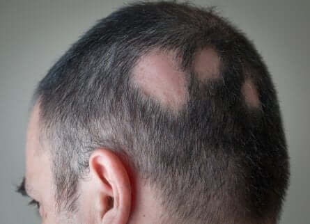 Haarausfall auf dem Kopf eines Mannes
