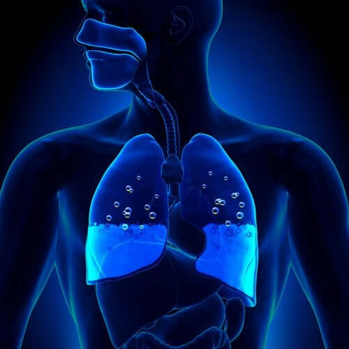 Lungenödem: Symptome und Ursachen